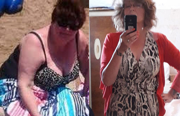 Price of Gastric Band Abroad with Weight Loss Riga
