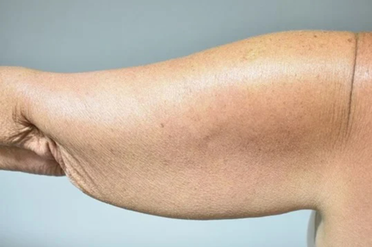 Dealing with Sagging Skin After Gastric Bypass