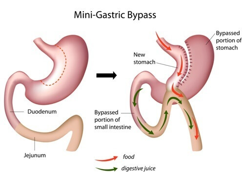 Can I have a Mini-Gastric Bypass if I have Heart Disease_-weight loss riga - Life improvements after gastric bypass surgery