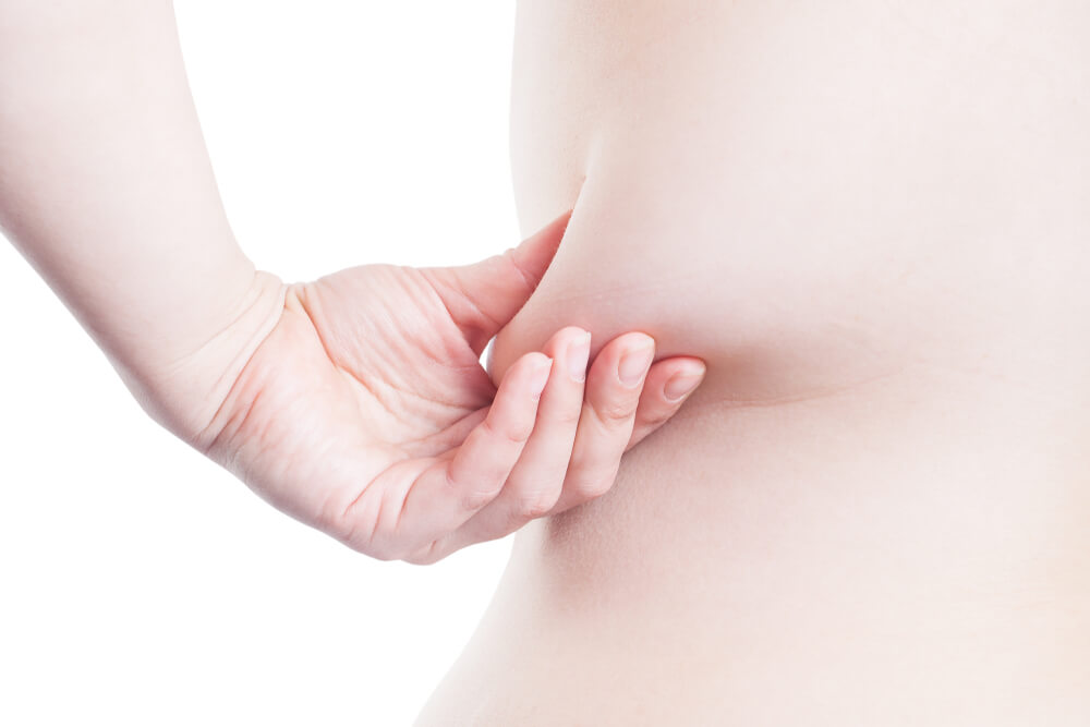gastric bypass surgery-weight loss riga-sagging skin-prevent sagging skin-weight loss riga (1)